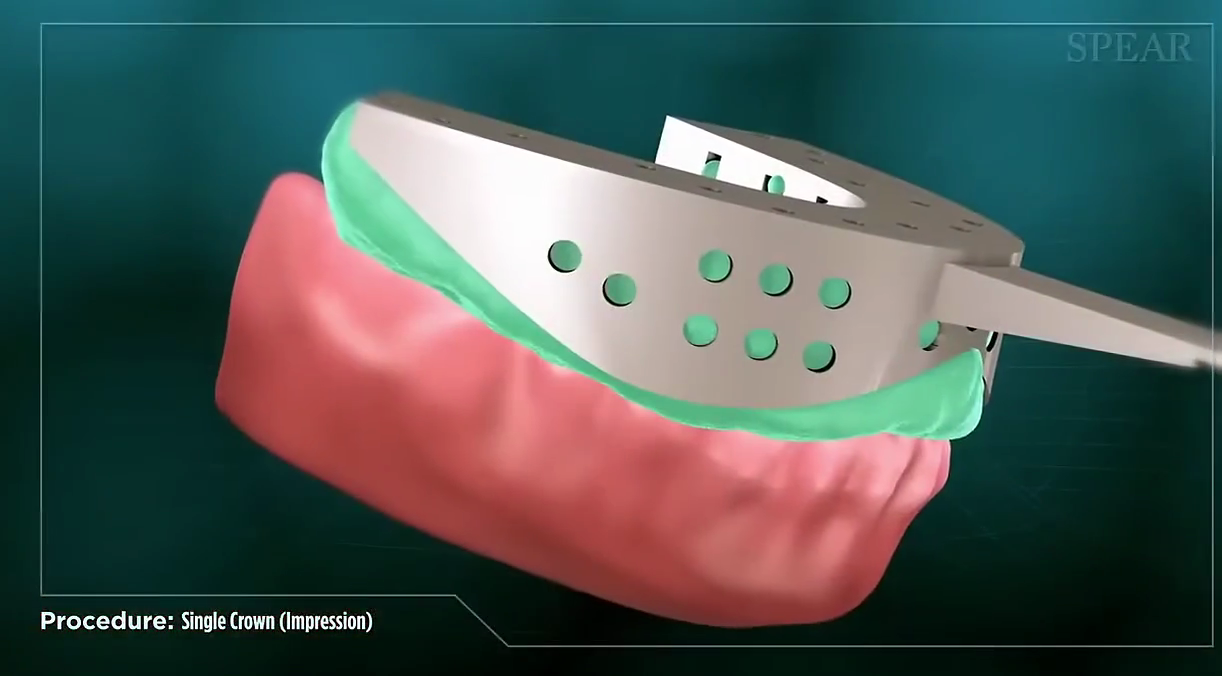 Step #3: Take a second impression of the newly prepared tooth to capture its exact anatomy for the dental laboratory.