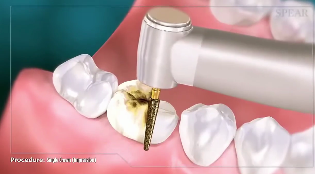 Step #2: Prepare the tooth for the crown by shaping it with a high-speed handpiece to make room for the new restoration.