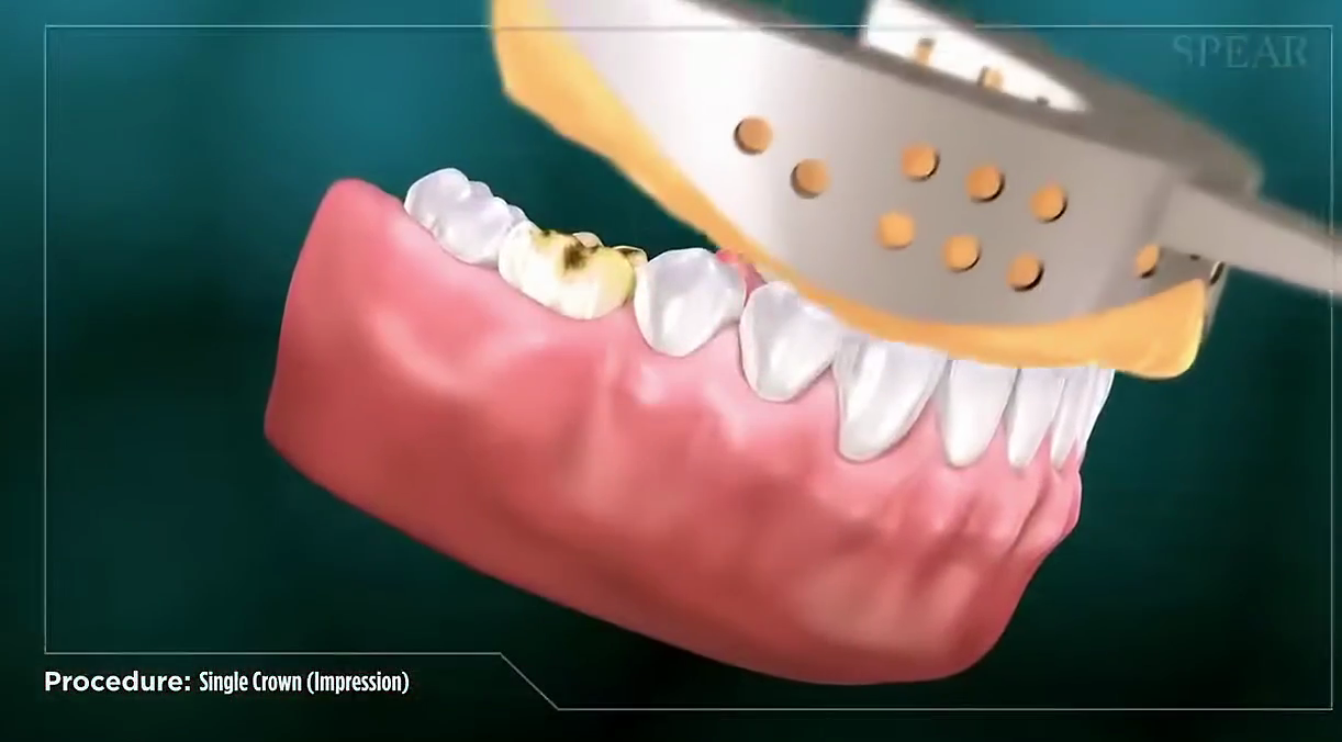 Step #1: Take an initial impression or mold of the lower teeth to help create a temporary crown for the damaged tooth.